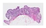 Colon - Invasive Adenocarcinoma