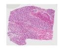 Utuerus - Lelomyosarcoma