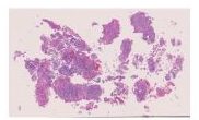 113-Invasive high grade papillary urothelial carcinoma